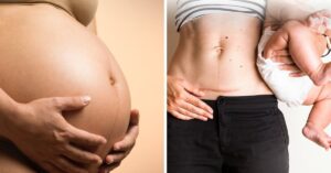 cesarean delivery and ways to prevent it