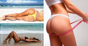 Sculptra Butt Lift